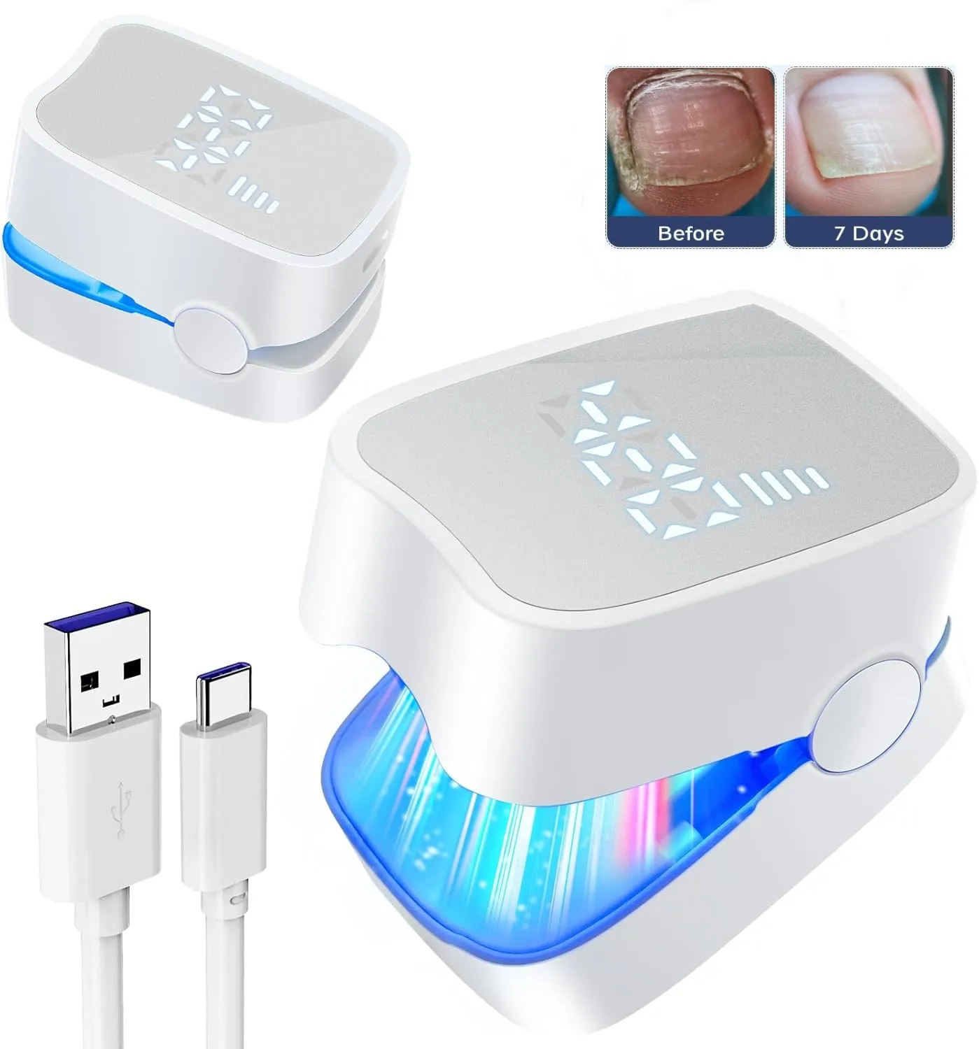 Nail Fungus Remover Personal Health Care Laser Therapy Pen Nail Fungus Laser Device with Time Display 470nm950nm wavelength for Finger/Toenails