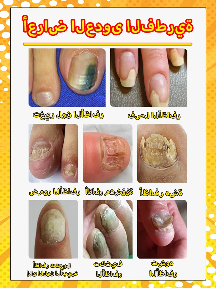Fungal Nail Product fungus solution