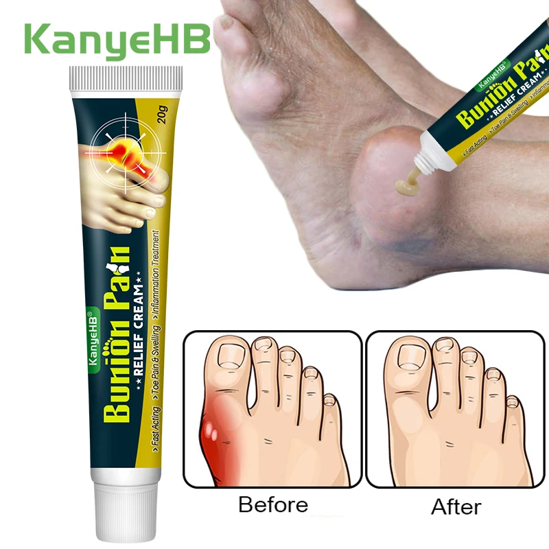 

1Pcs Gout Treatment Cream Finger Toe Bunion Joint Pain Relief Herbal Medical Cream Foot Bone Thumb Corrector Care Ointment G049