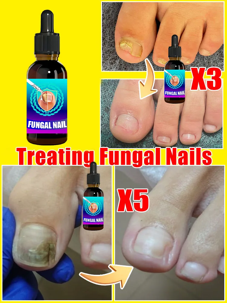 Fungal Nail Treatment Serum Foot Nail Fungus Removal Repair Gel Anti Infection Paronychia Onychomycosis Foot Nails Care Essence