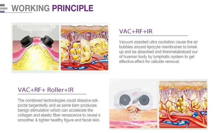 Máquina velashape a la venta -Principio de funcionamiento