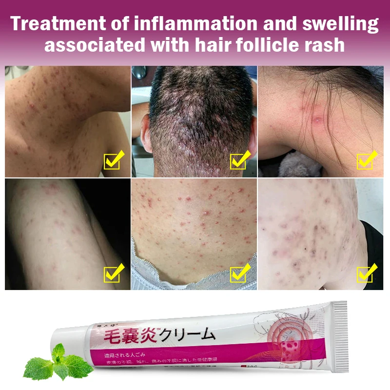 3Pcs Folliculitis Psoriasis Cream Treat Dermatitis Eczematoid Antibacterial Anti-Itch Herbal Medical Skin Care Ointment A1712