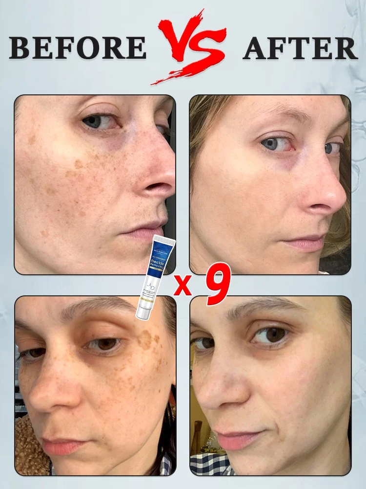 Рисунок 4 - Крем для веснушек