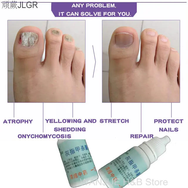nail podiatry ingrown toenail onychomycosis antifungal for nail fungus