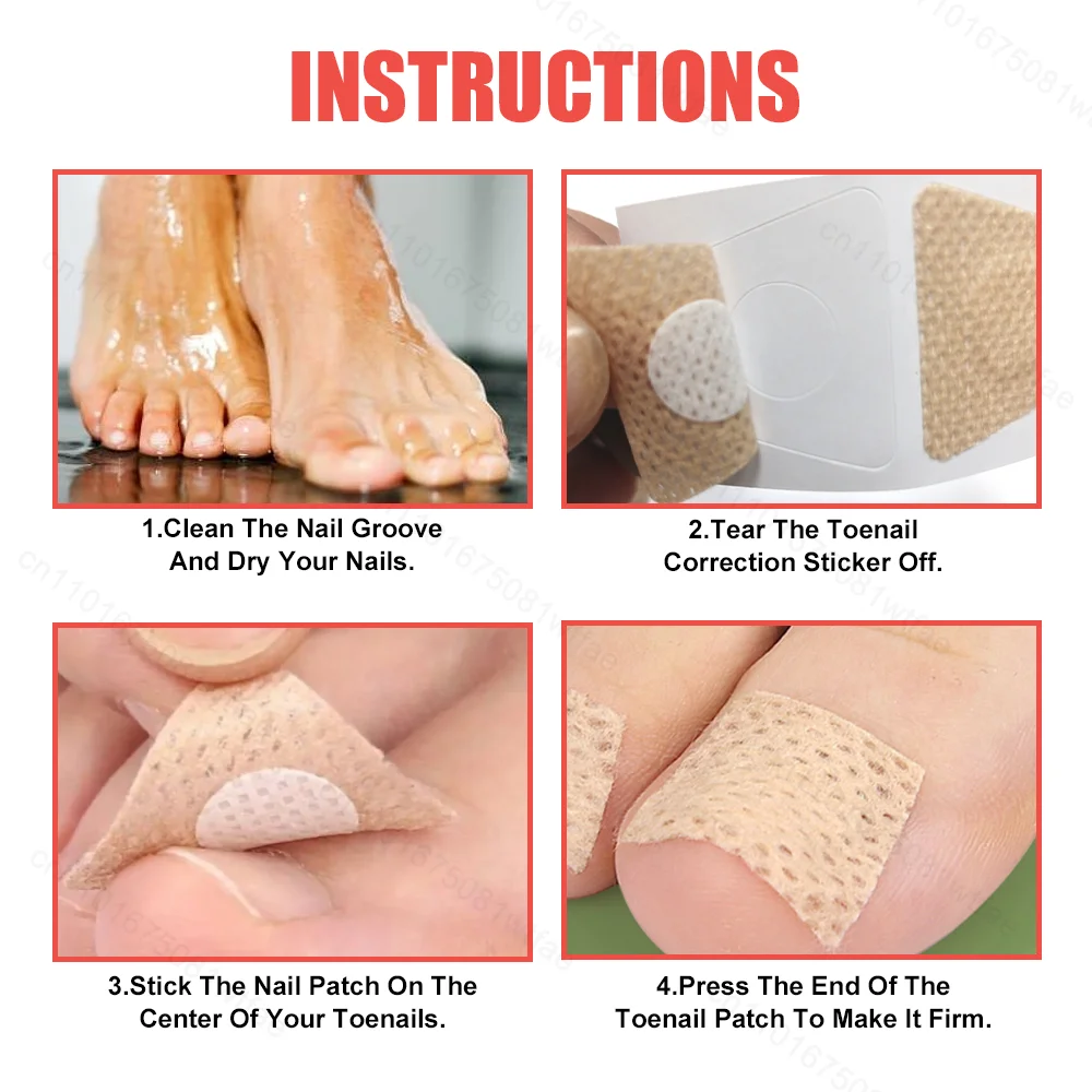 Toenail Fungus Treatment Patches Ingrown Correction Waterproof Sticky Nail Repair Sticker Discolored Damaged Fungal Nails