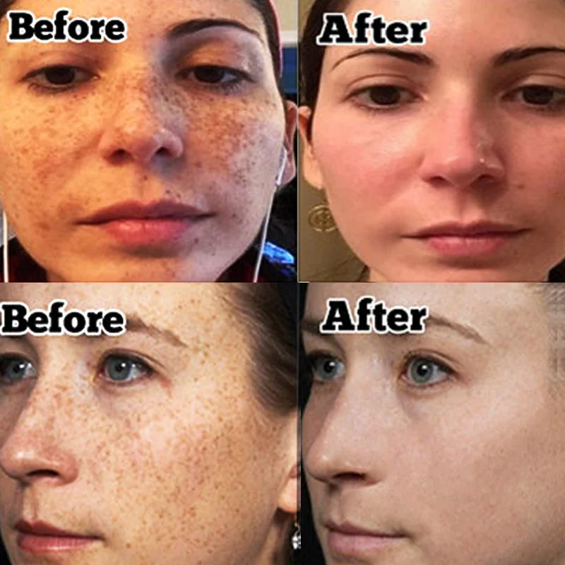Niacinamide Whitening Freckles Serum Removal Melasma Dark Spots