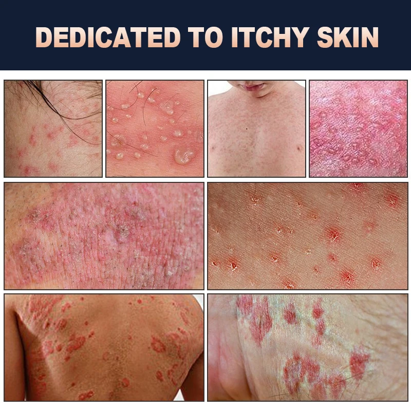 Antibacterial Cream Eczema Ointment Remove Odor Private Part Dermatitis Anti-itch Cream Tinea Cruris Psoriasis Plaster Skin Care