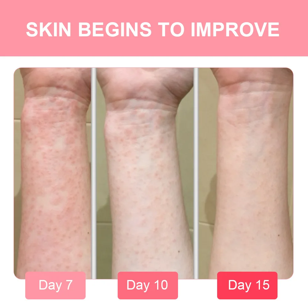 Sumifun, calamine, wet poison ointment, antiseptic plaster, itching skin care