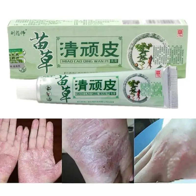 Chinese Herbal Medicine Skin Cream For Anti-itch Allergies Dermatitis Eczema Pruritus Psoriasis Ointment External Use Plaster