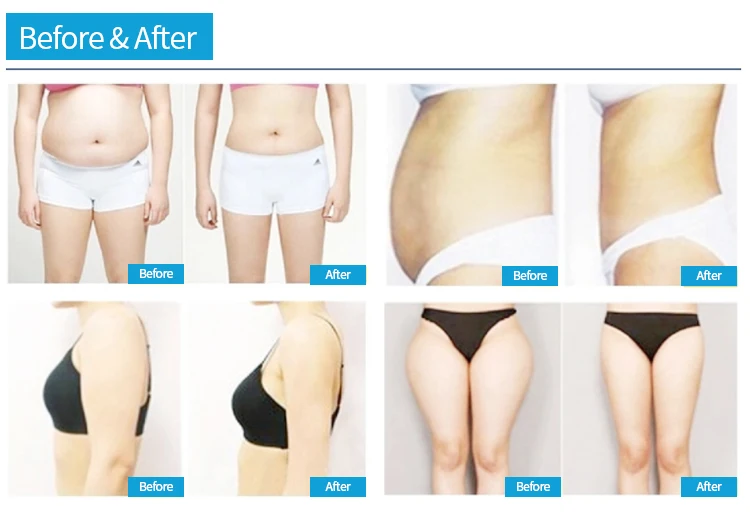 Portable Professional 360 Degree Rolling Cellulite Massager 5D Vacuum Roller Slimming Machine For Lymphatic Drainage 360 Degree Rolling Cellulite Massager for Lymphatic Drainage 8d roller massage machine,Roller massage,Cellulite reduction machine