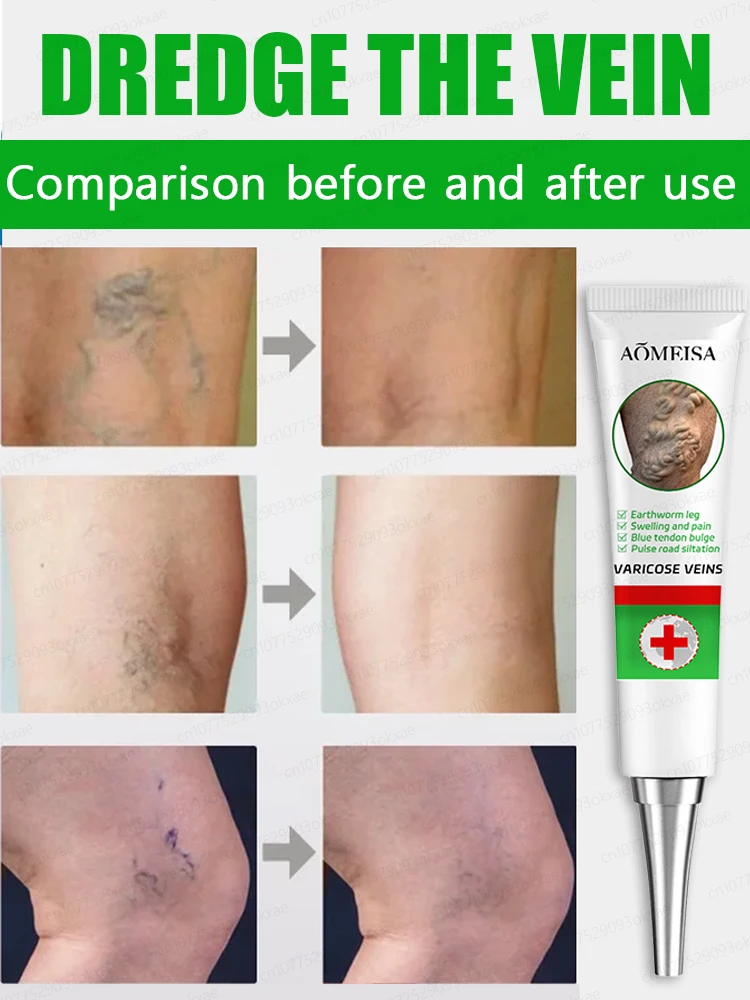 Effective Varicose Vein Relief Cream Ointment For Varicose Veins To Relieve Vasculitis Phlebitis