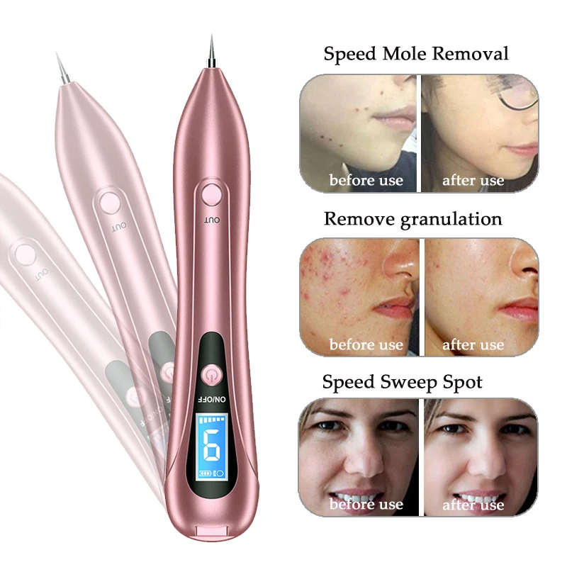 LCD Face Plasma Pen Skin tag remover pen Tattoo removal Black dot Dark Spot  verrgas pencil remove warts Laser Mole Removal tools - AliExpress