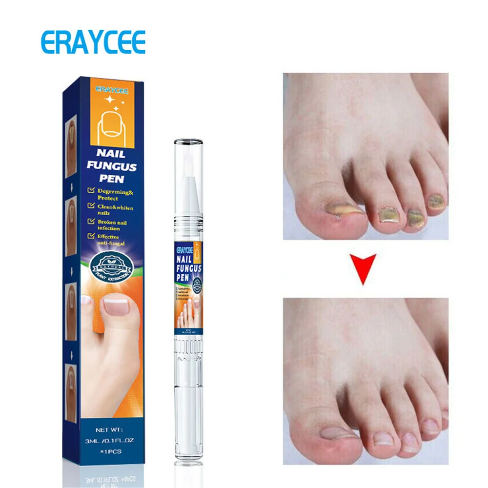 1Pcs Painless Fungal Nail Treatment Pen Onychomycosis Paronychia Anti Fungal Treatment Painless Nail Repair Pen Grey