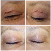 Plasma Pen – Eyelid Lift, Wrinkle & Dark Spot Removal
