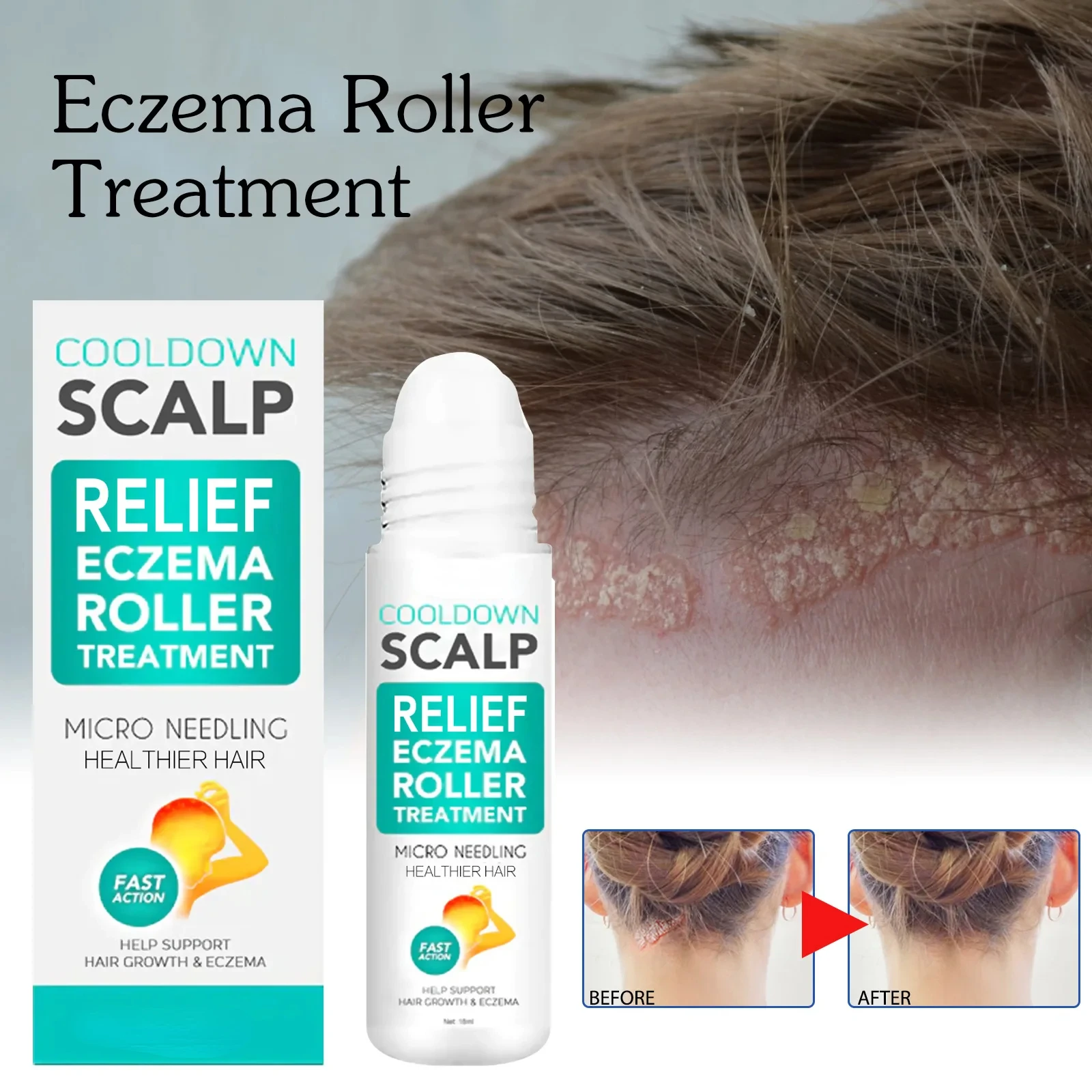 Seborrheic Dermatitis Cream Scalp Care Treatments Repair Scalp Relieve Itching Remove Dandruff Healthy Skin Hair Growth 18ml