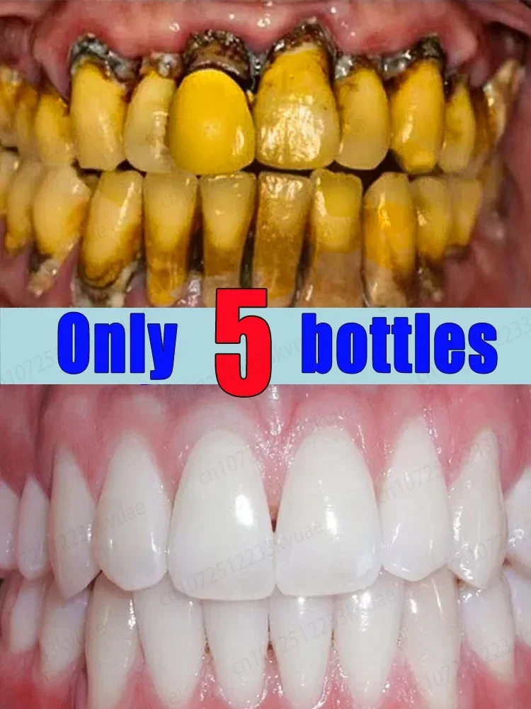 

ᵀᵉᵉᵗʰ ᶜˡᵉᵃⁿⁱⁿᵍ ᵈᵉᵛⁱᶜᵉ⸴ ʷʰⁱᵗᵉⁿⁱⁿᵍ ᵗᵉᵉᵗʰ⸴ ʳᵉᵐᵒᵛⁱⁿᵍ ᵗᵃʳᵗᵃʳ⸴ ᵖˡᵃᑫᵘᵉ ᵃⁿᵈ ʸᵉˡˡᵒʷ ᵗᵉᵉᵗʰ