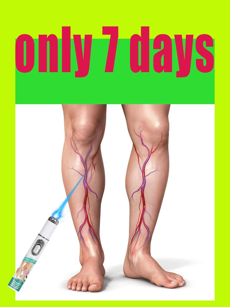 This kind of laser therapy for varicose veins&mdash;It can help ease that leg discomfort