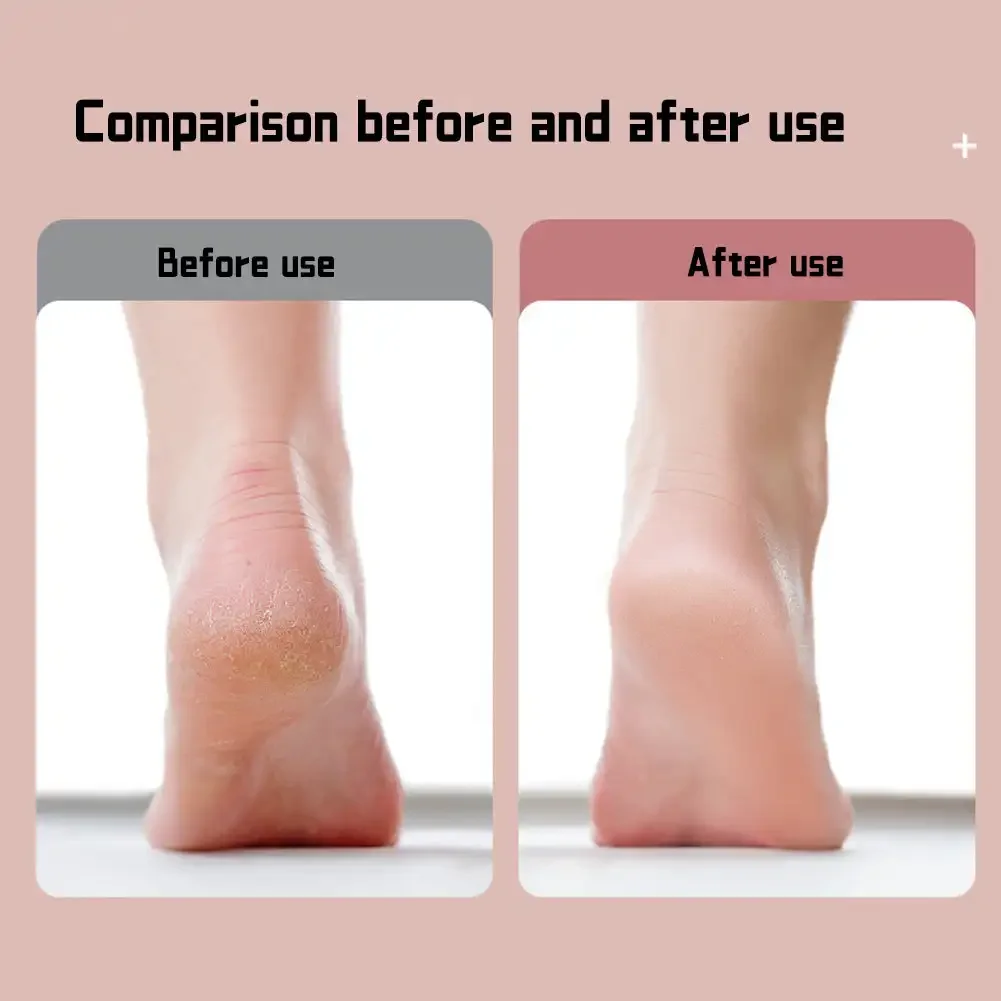 Râpe ménagère pour éliminer les callosités et les callosités, lime électrique pour les pieds secs, abîmés et crevassés, et réparation._voghion.com