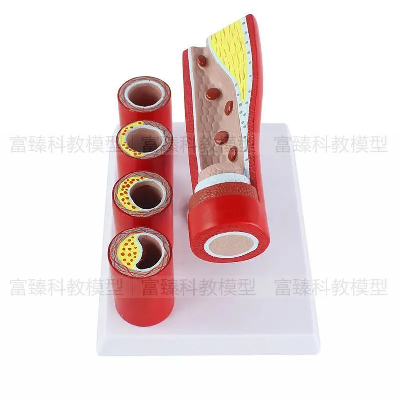 

Эндометрическая Анатомия медицинской артериальной модели для имитации патологических изменений сосудистого стеноза при атеросклерозе крови