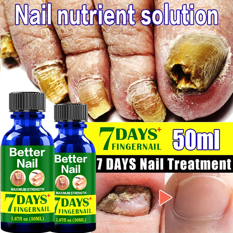 7days Fungal Nail Repair Serum Care Treatment Foot Nail Fungus Removal
