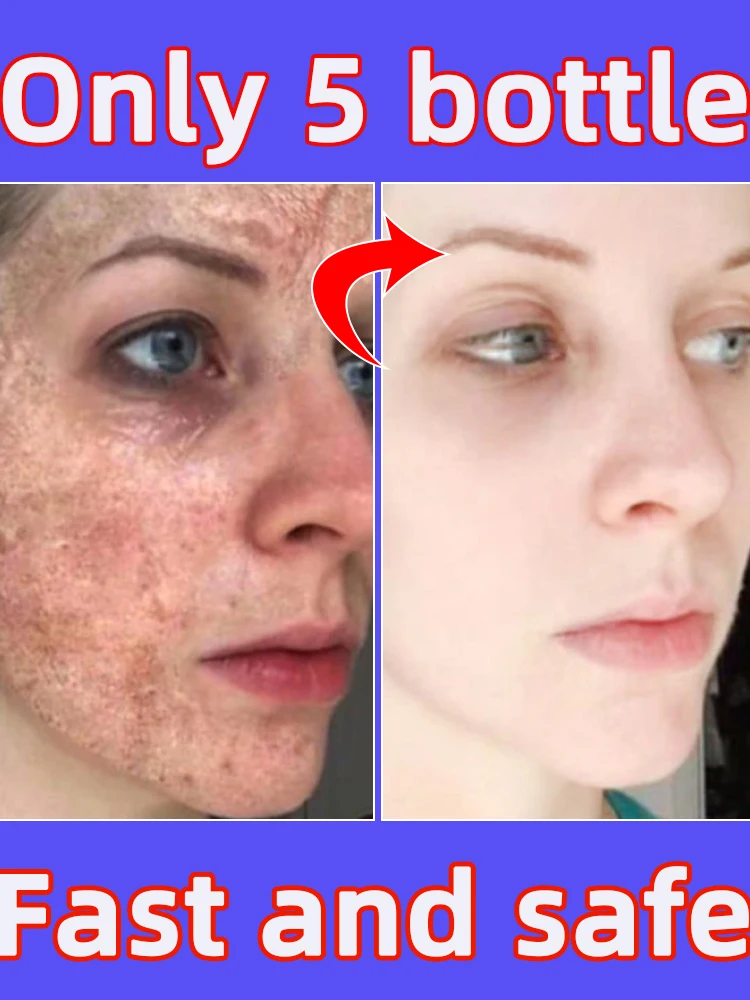 

Dark Spot Remover Melasma Chloasma Freckles Spot Removal Cream