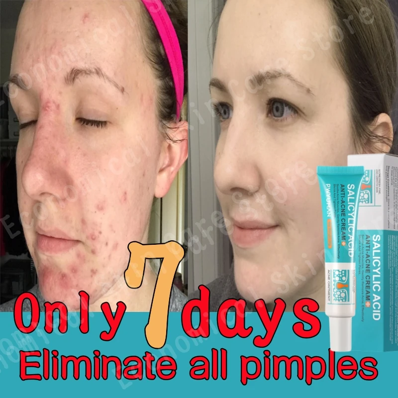 Salicylic Acid Acne Before And After