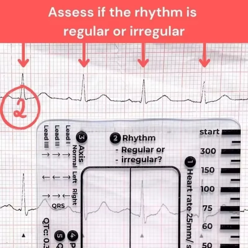 Ecg 7 Step Ruler 7 Step Scale for Ecg Observation Portable Transparent 7step Ruler Measurement Tool for Interpretation measurement tool