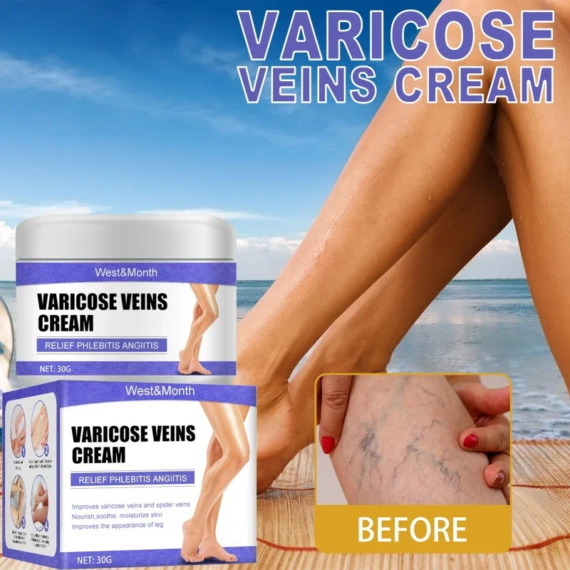 

ointment for varicose veins Effective varicose vein relief cream to relieve vasculitis phlebitis spider pain treatment Body Care