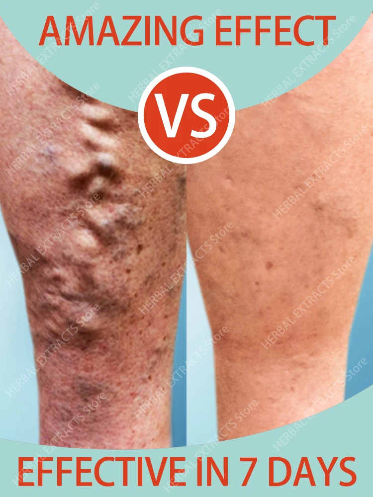 

Effective Varicose Vein Relief Cream Eliminate Vasculitis Phlebitis Spider Legs Treatment Soothing Relieve Pain