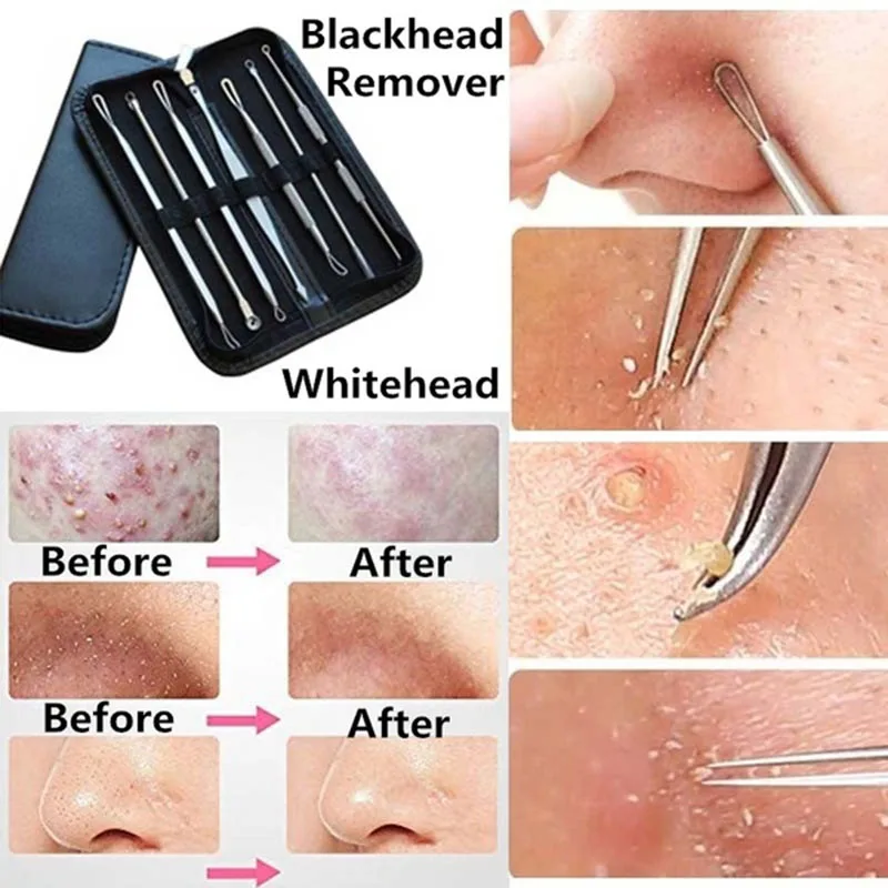9pcs Stainless Acne Needle Blackhead and Pimple Remover Face Care Comedone Extractor Head Remover Tool Sets Point Clean Black