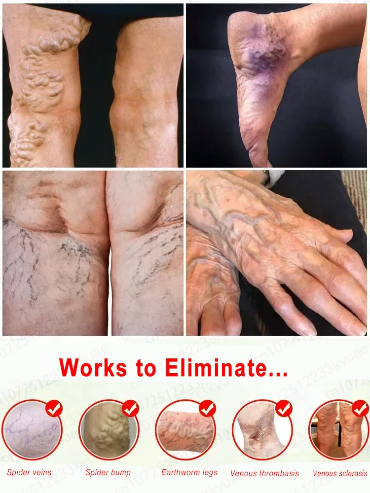 Varicose vein ointment, repair varicose veins and vasculitis in 7 days