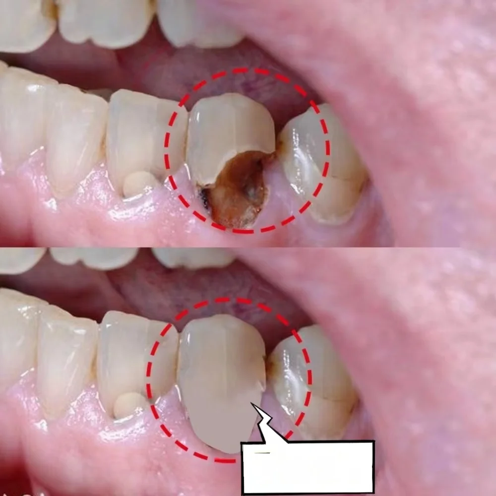 Carie Buraco no Dente: Entenda o Problema e Como Evitá-lo, image size:1000x1000