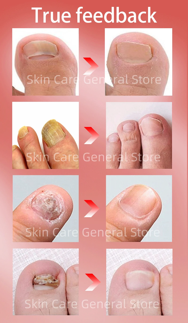 NailFungalTreatmentSerumOnychomycosisParonychiaAntiInfectionToe