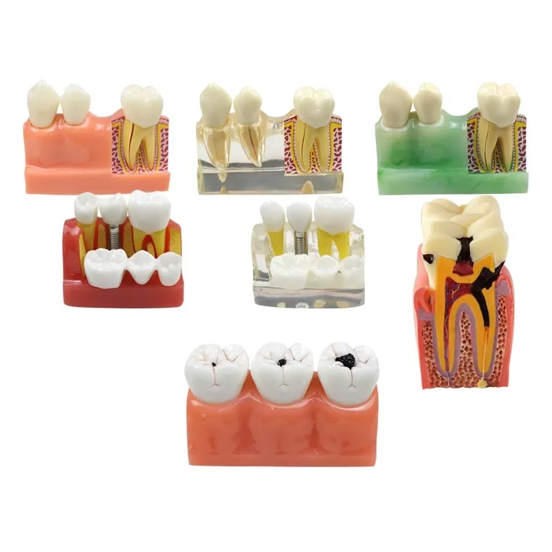 

GREATLH Dental Teeth Model 4Times Caries Model Dental Implant Model Removable Teeth Dentist Learning Tools Dental Materials