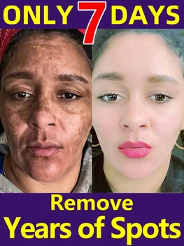 Lentiggini crema macchia scura 1