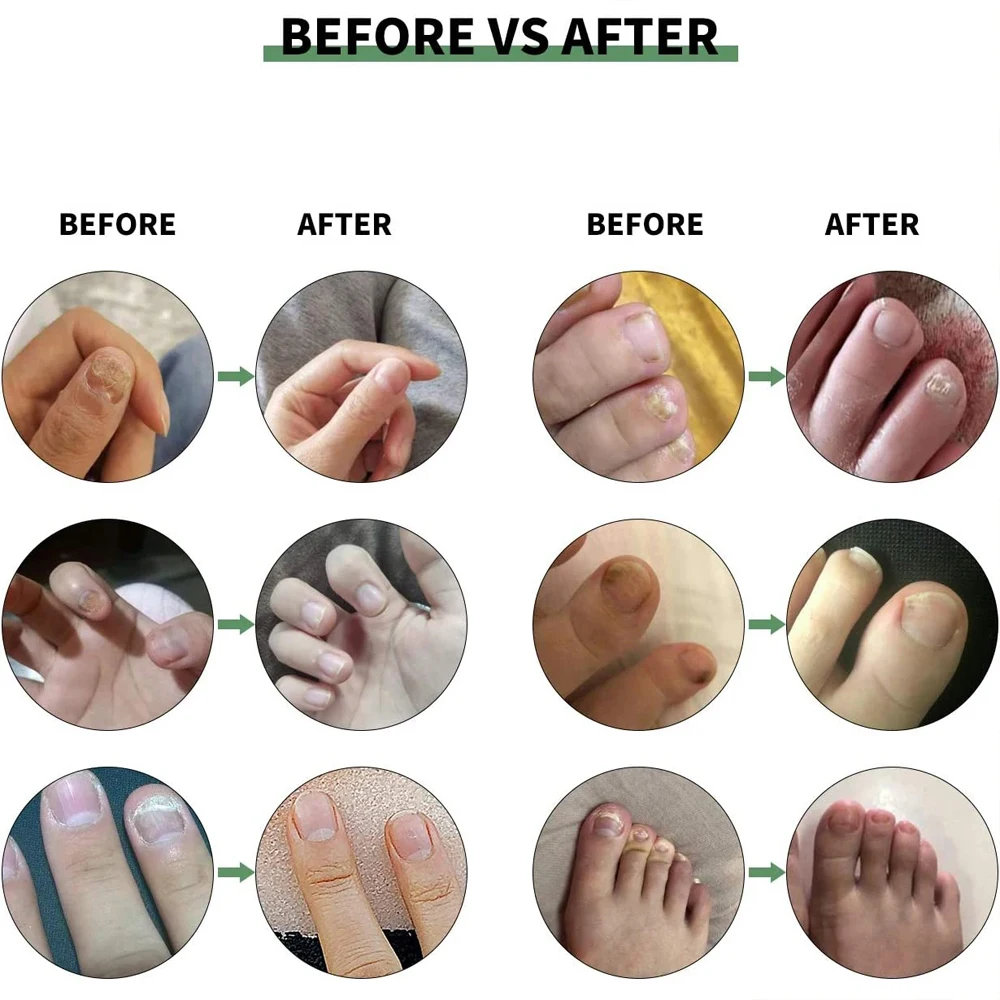Jemeesen Nail Fungus Treatment Gel Foot Care