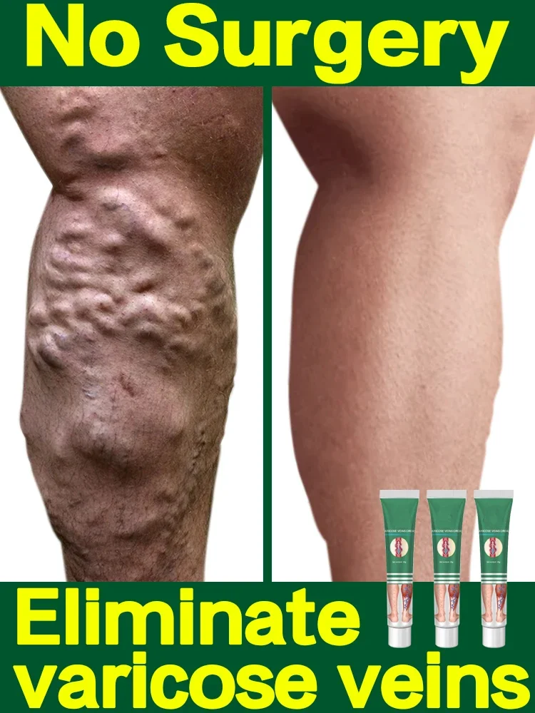

Varicocele ointment, an effective cream for relieving varicose veins, treating spider pain, vasculitis, and phlebitis