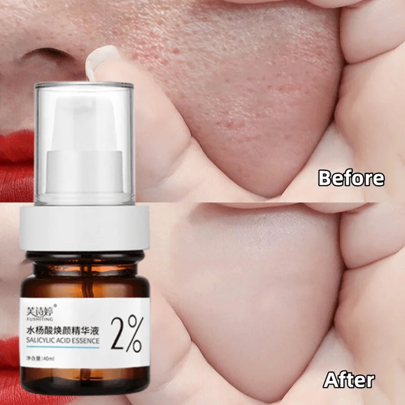 

Mildest %2 Salicylic Acid Shrink Pore Face Serum Acne Blackhead Removal Serum Whiten Brighten Spots Deep Moisturize Skin Care