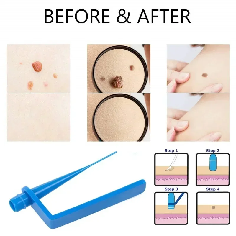 Skin Care Rubber Bands Skin Tag Remover Skin Tag Removal Kit Face Care Mole Wart Tool Skincare Green Beauty & Health 4