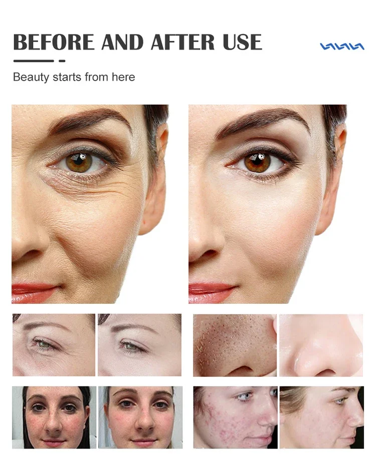 Professional 17-in-1 Hydrafacial Machine Hydro Dermabrasion Skin Care System 15 Professional 17-in-1 Hydrafacial Machine Hydro Dermabrasion Skin Care System