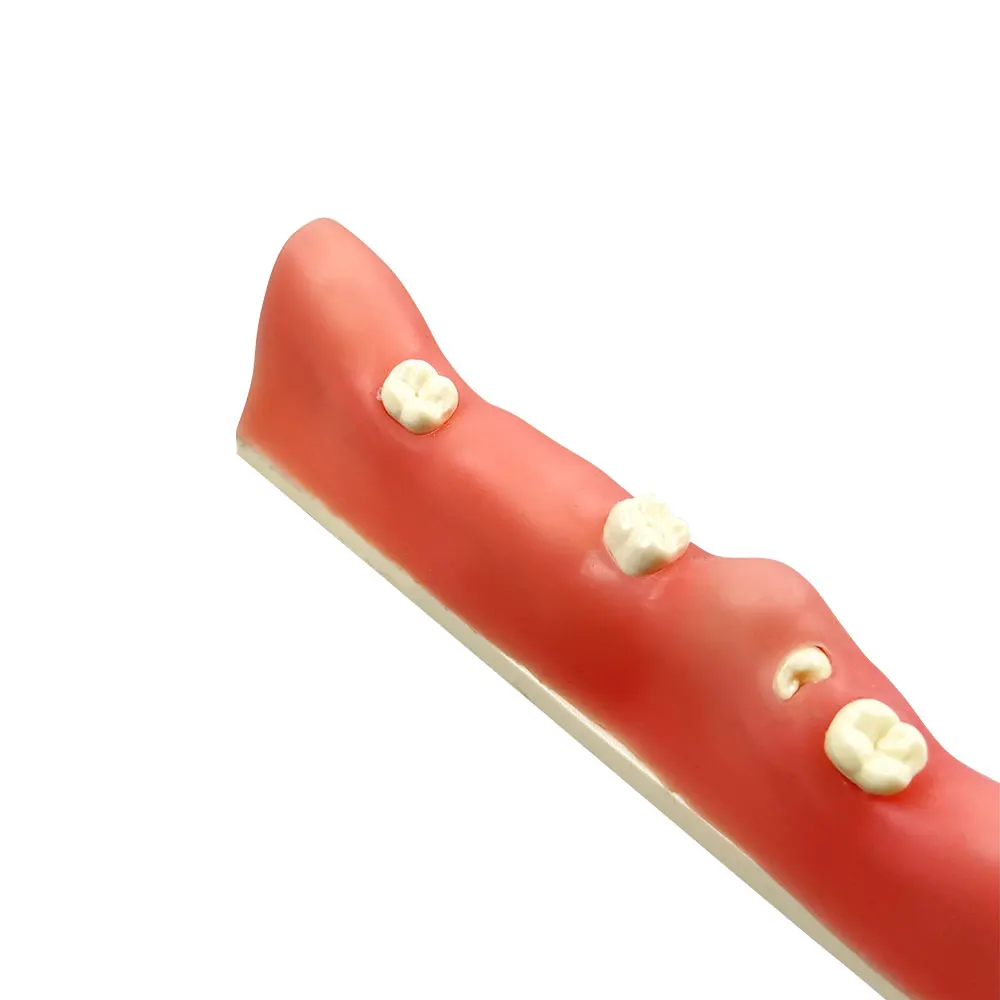 치과 임플란트 치아 추출 연습 모델 레진 재료 지혜 치아 교육 학습 모델 치과 시연 도구