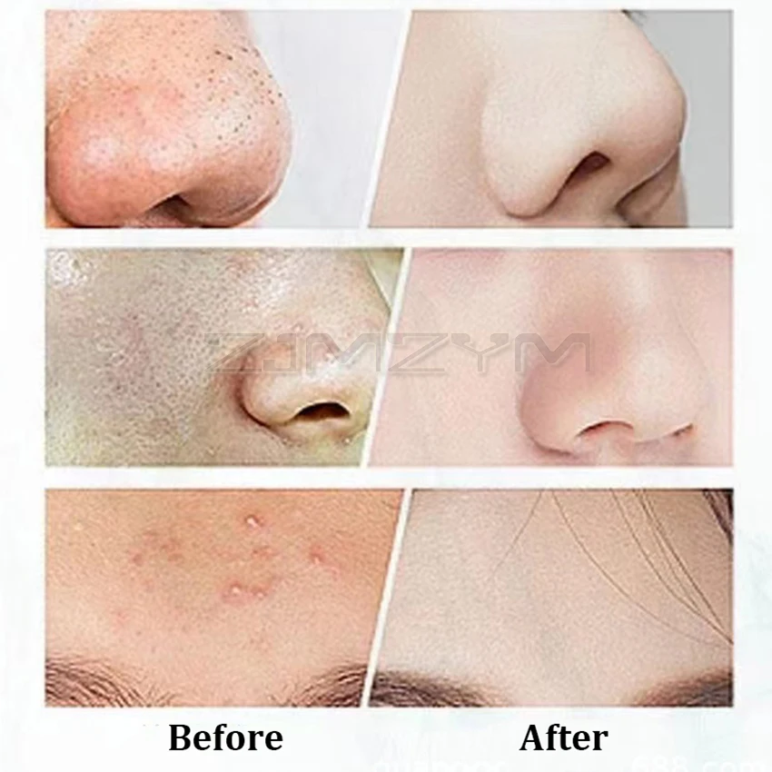 Hot sell High Frequency Portable Pore Cleansing Skin Scrubber Facial Cleansing Remove Blackheads Skin Care Device