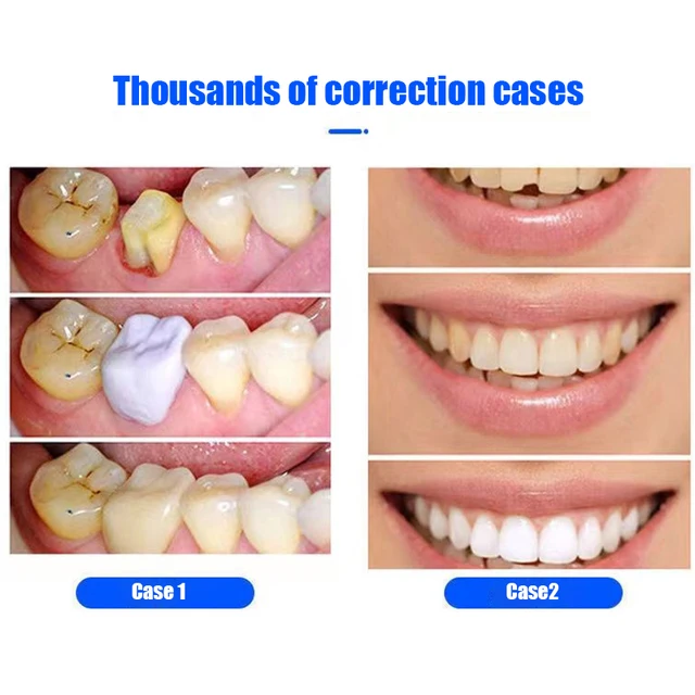 Sdotter New Resin Tooth Repair Kit 5g/10g/15g/20g FalseTeeth Gaps