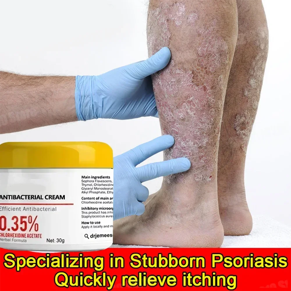 Psoriasis Antibacterial Anti-itch Dermatiti Eczema Urticaria Alergy Skin Beauty Health Body Care