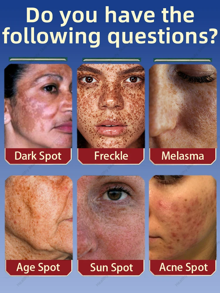 Solves all Freckles Problem