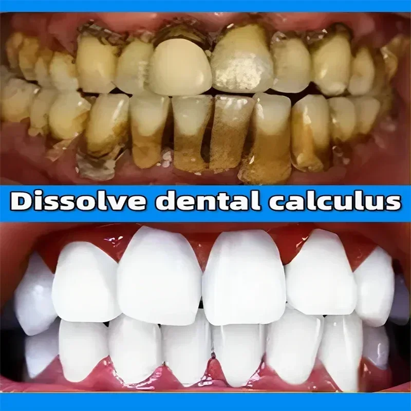 Dental Calculus Remover Whitening Removal Bad Breath Teeth Toothpaste Brightening Preventing Periodontitis Dental Cleansing Care teeth whitening product teeth whitening essence dental calculus remover teeth health product