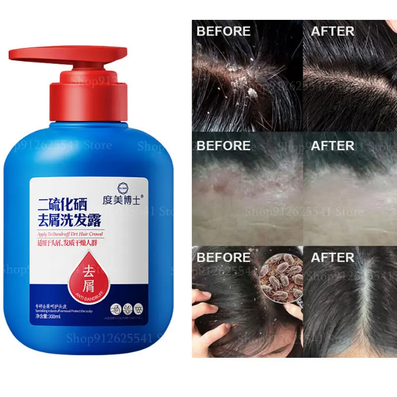

300ml Therapeutic Shampoo Anti-Dandruff Treatment Itching Flaking Scalp Psoriasis Seborrheic Dermatitis Oil Control Fluffy