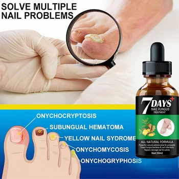 7DAYS Nail Fungus Treatment Essence Serum Care Hand and Foot Care Removal Repair Gel Anti-infective 5