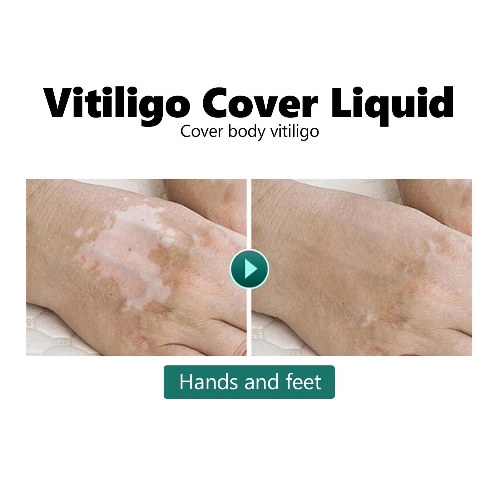 Waterproof Vitiligo Cover Liquid 20ml Makeup Concealer Cosmetics For Face Body liquid concealer makeup concealer waterproof concealer face concealer