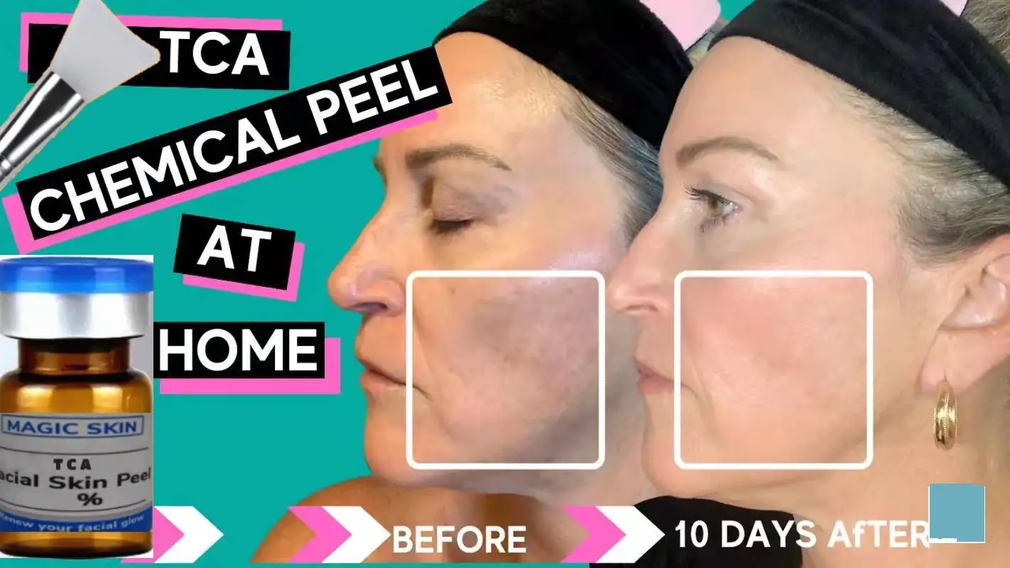 AcidPeelforDarkSpotsExfoliatingReduceWrinklesAcneScars